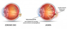 Jaskra – niebezpieczna choroba oczu